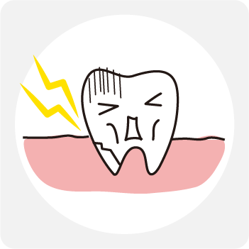 歯の破折が原因で歯がしみる