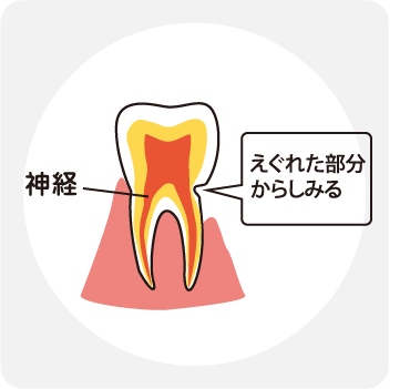 くさび状欠損が原因で歯がしみる