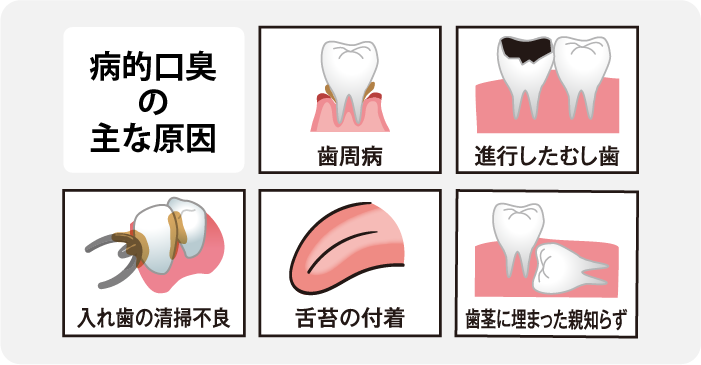 病的口臭の原因